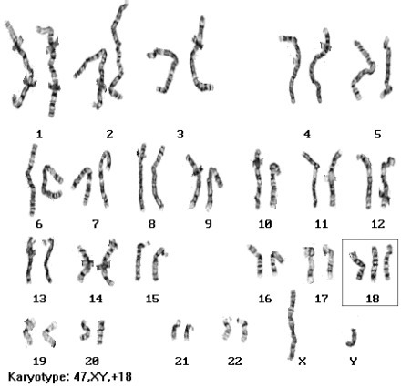 The karyotype indicates a problem with chromosome 18. What is the problem and what-example-1