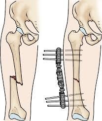 How does the shape of the treated femur compared with that of the untreated femur-example-1