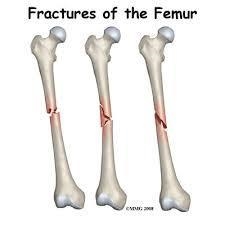 How does the shape of the treated femur compared with that of the untreated femur-example-4