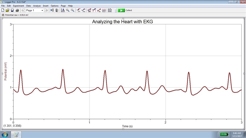 Is this ECG/EKG normal?-example-1