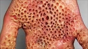 This is a real thing true or false its called trypophobia disease-example-1