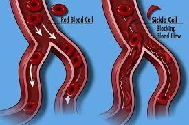 What is the effect of sickle cell anemia-example-1