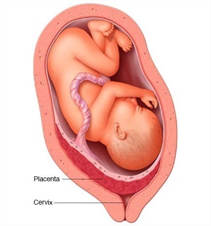 What would occur if a fetus's villi tissue ruptured?  The maternal tissue of the placenta-example-1