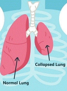 Alveoli are most likely to collapse (resulting in atelectasis) when which condition-example-1