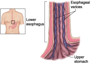 ​which term means enlarged and swollen veins at the lower end of the esophagus? a-example-1