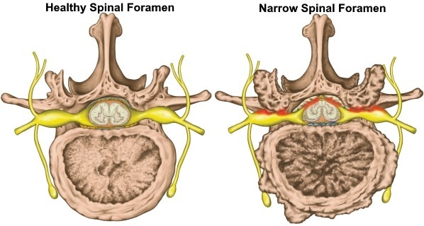 Arthritis and other similar diseases can cause a narrowing of the spinal foramen. The-example-1