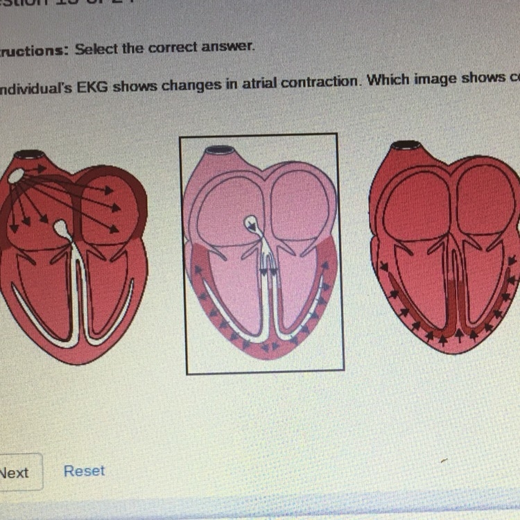 What image shows contraction of the atria?-example-1