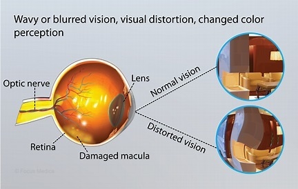 Smoking can increase someone's risk for developing macular degration. T/F-example-1