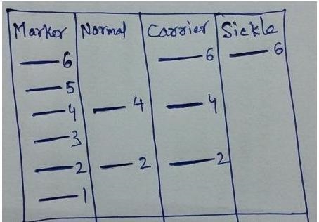 The substitution of a T for an A in the protein coding sequence of the globin gene-example-1