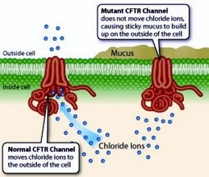 The most commonly occurring mutation in people with cystic fibrosis is a deletion-example-1