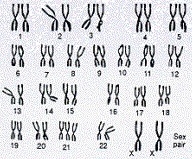 Which chromosome is abnormal or carries a genetic mutation? A. 13th pair B. 21st pair-example-1