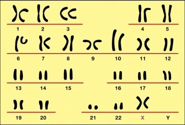 The female with this karyotype would have which genetic disorder? A. Klinefelter's-example-1