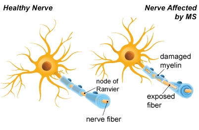 Multiple sclerosis (MS) is a disease that affects the nerve cells of the brain and-example-1