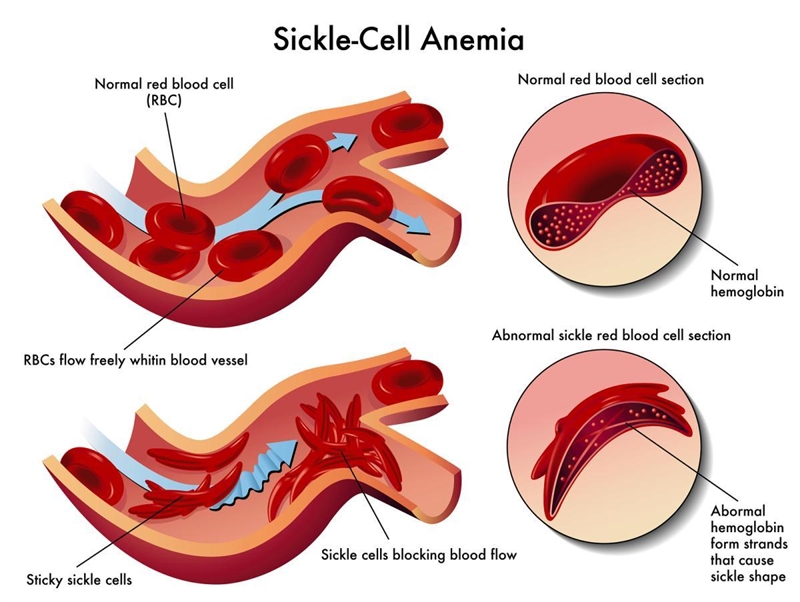 What organelle does sickle cell anemia affect?-example-1