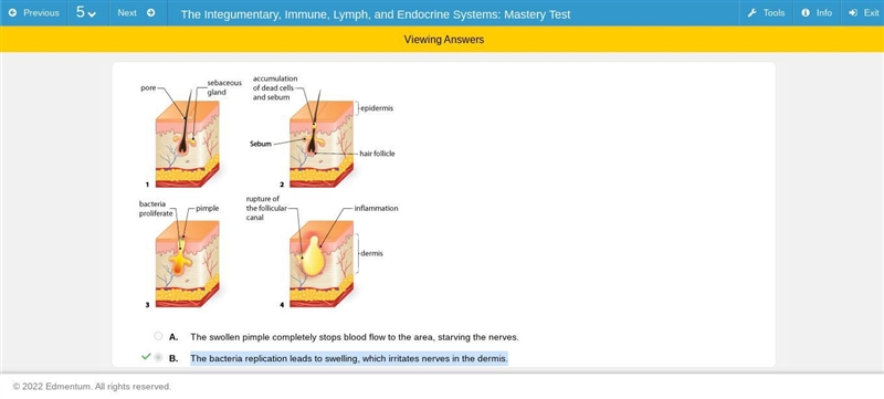 The model shows how pimples are formed in the skin. Why do you think this process-example-1