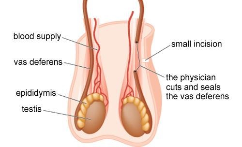 How does this procedure serve as a method of birth control?-example-1