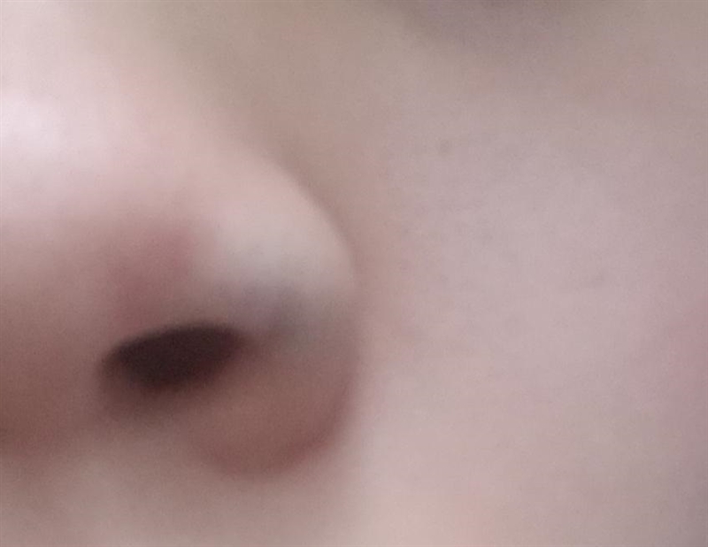 What's this on my nose? Been on for more than 5+ years. Please help me out if you-example-1