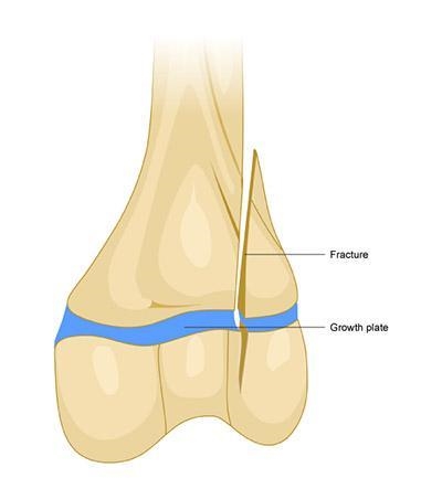 Please Help!!!! "Each long bone has at least two growth plates, also called epiphyseal-example-1