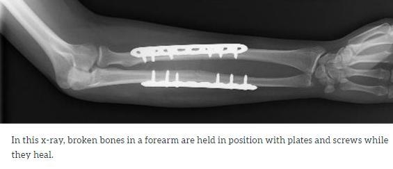 Which type of fixation of a fracture usually is not removed after the fracture has-example-1