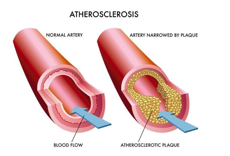 What is the impact of arteriosclerosis​-example-1