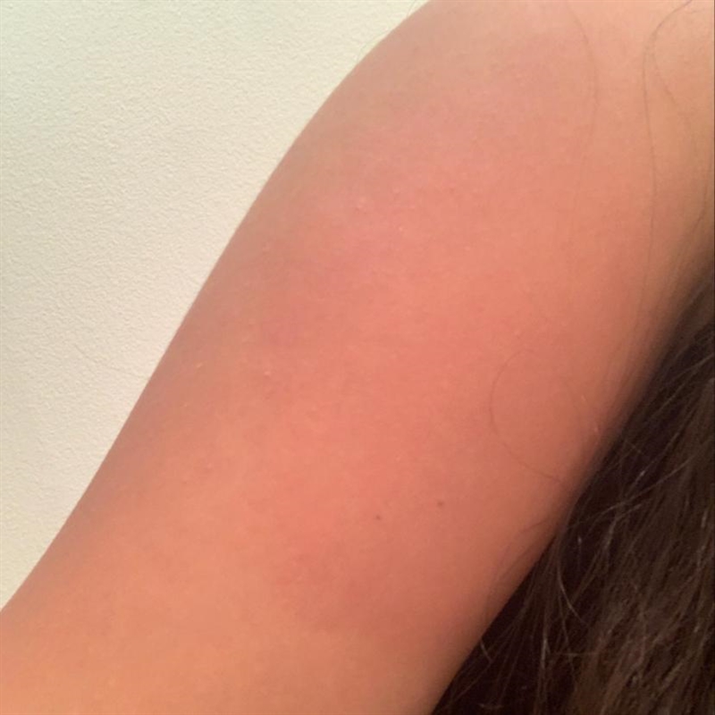 When you go to the doctors and a 2 shots on one arm. After 1 day is it common to get-example-1