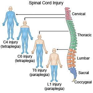 Sometimes the spinal cord can be damaged in an accident. Depending on the location-example-1