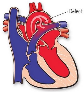 Friends what is Turner syndrome, Marfan syndrome,and patent ductus arteriosus???? plzzzz-example-2