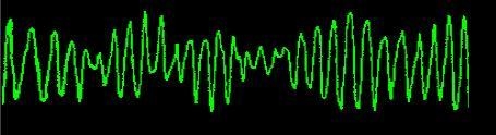 What is this heart rhythm? A. Ventricular fibrillation B. Torsade De P. C. Asystolie-example-1