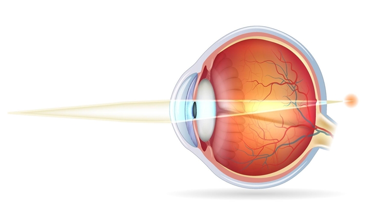 Which statement is true about a farsighted (hyperopic) eye? A. The image point is-example-1