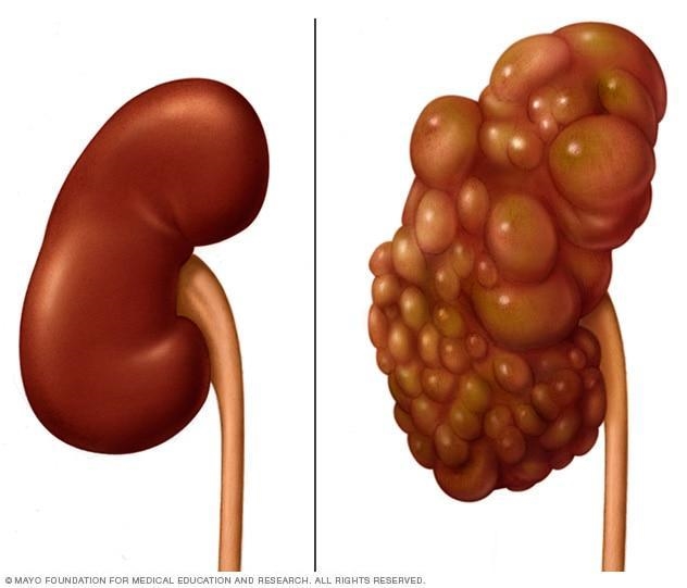 A young adult with a history of intermittent flank pain, repeated urinary tract infections-example-1