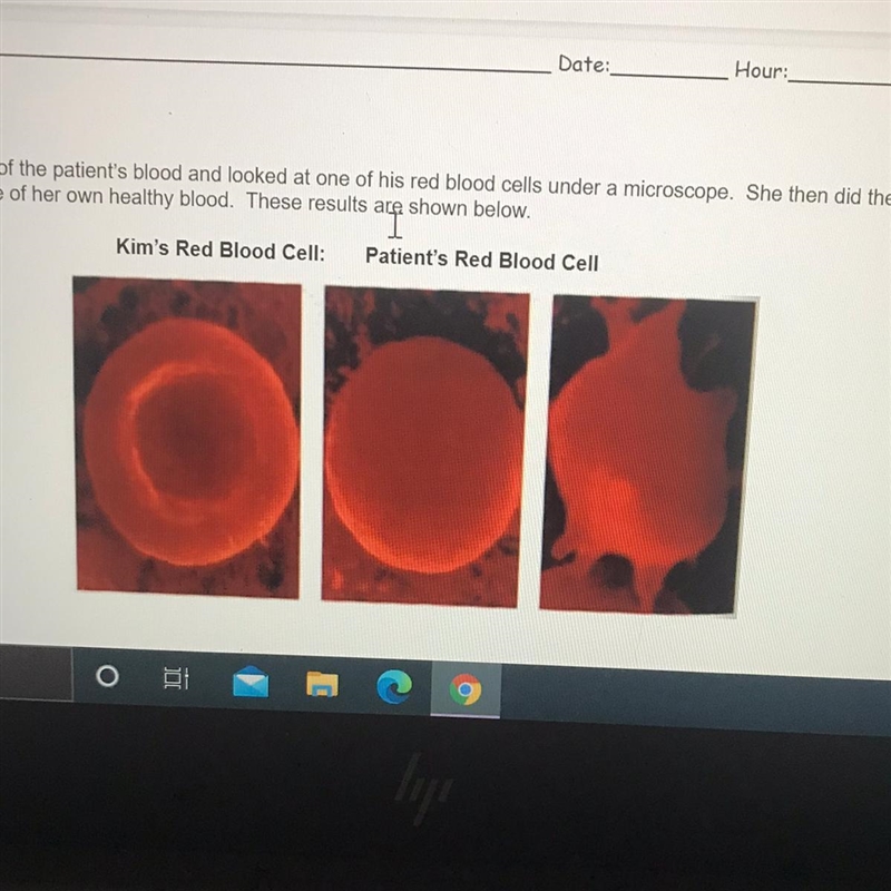 How does Kim’s red blood cell appear different from the patient’s? Why is this the-example-1