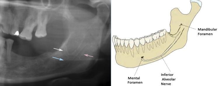 Based on what you know of bone features, what do you think this canal is for? Why-example-1