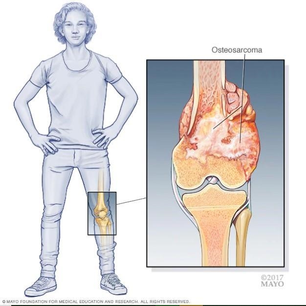 A 10-year-old boy has a metastatic lesion in the metaphyseal region of the femur that-example-1