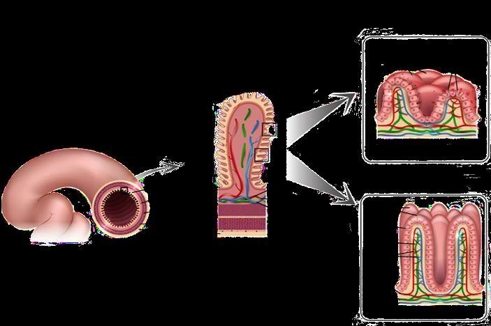 What effects would you expect uncontrolled celiac disease to have on children? How-example-1