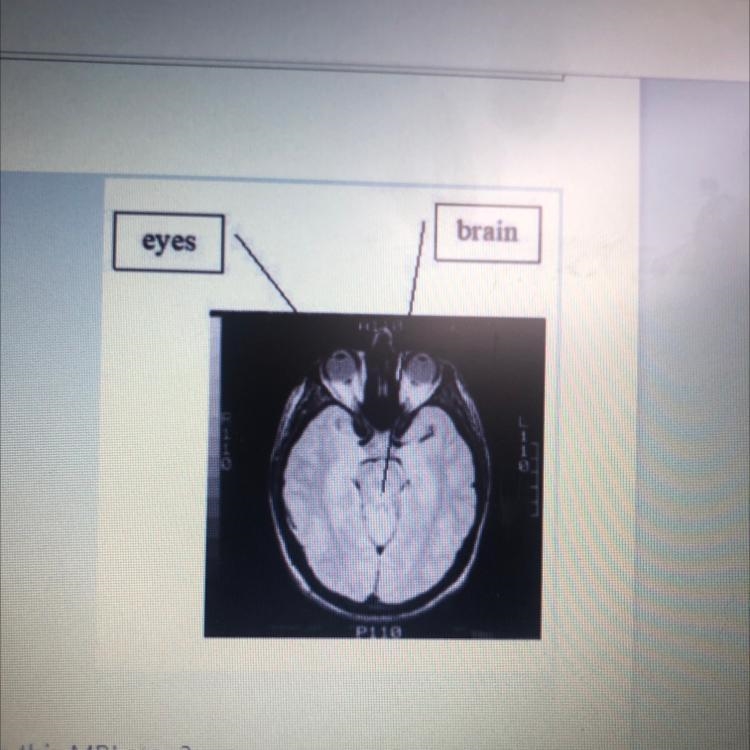 What surface of the body are the eyes located on in this MRI scan?-example-1