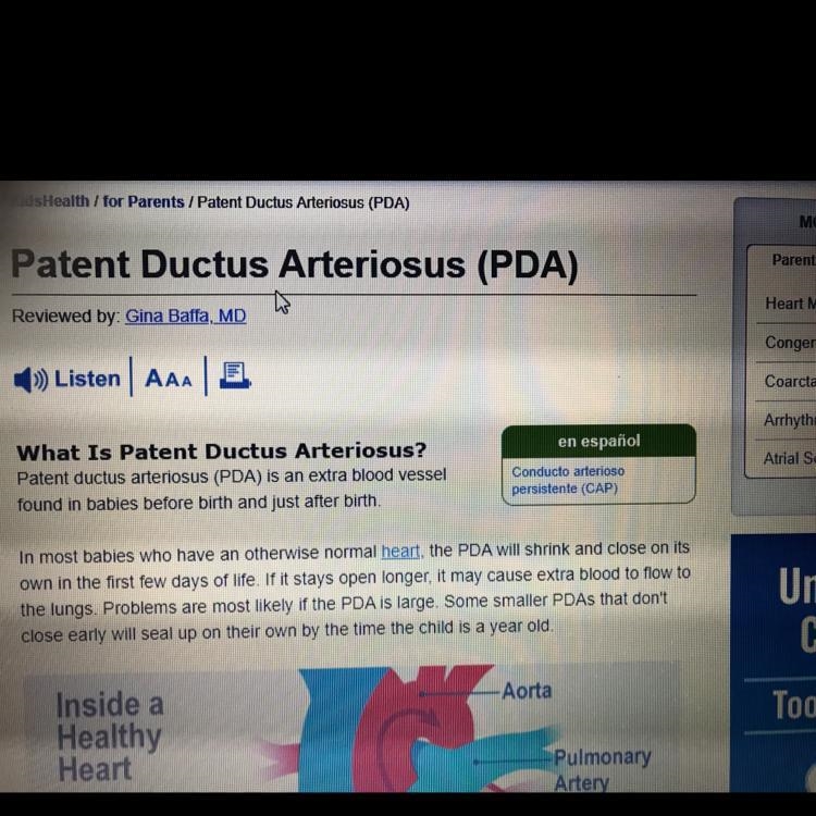 Propose what might happen to blood flow around the site of PDA W-example-1