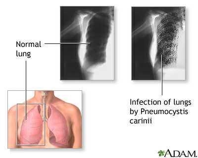 Which opportunistic infection complicates human immunodeficiency virus (HIV) and acquired-example-1