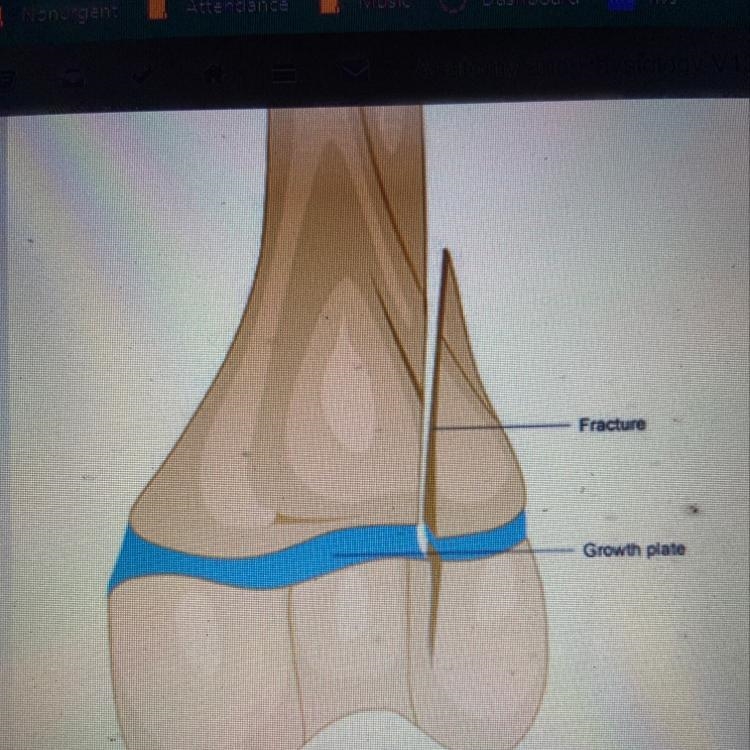 When a long bone is fractured at the epiphyseal plates, how will the fracture affect-example-1