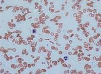 What is the genotype of a person who has sickle-cell trait?-example-1