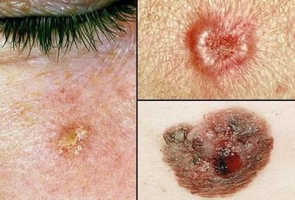 What is skin cancer and how does it occur?-example-1