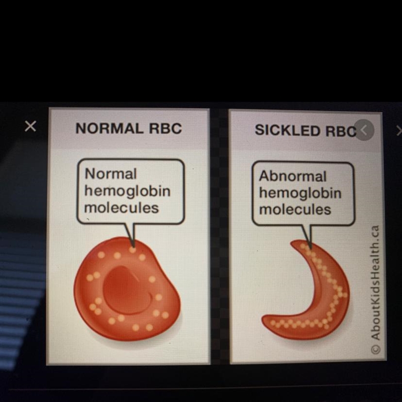 What is the sickle cell disease and how can it affect someone’s health??????-example-1