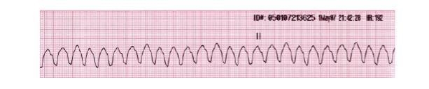 This picture shows what the heart rhythm looks like when there is an injury to the-example-1