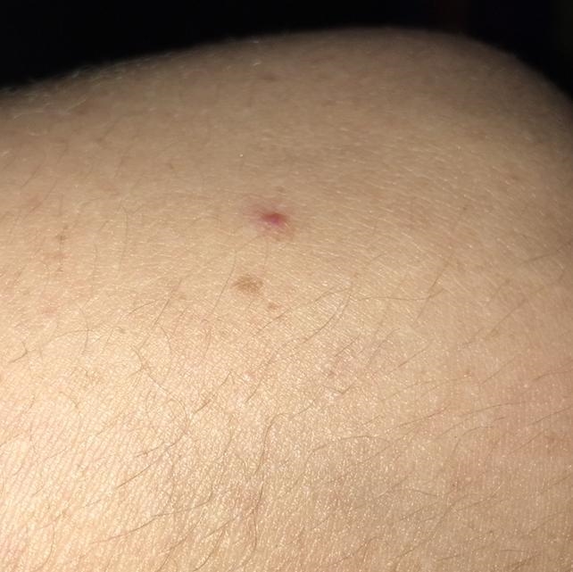 Does anyone know if these are bad. The internet said it’s blood clot. It’s on my elbow-example-1