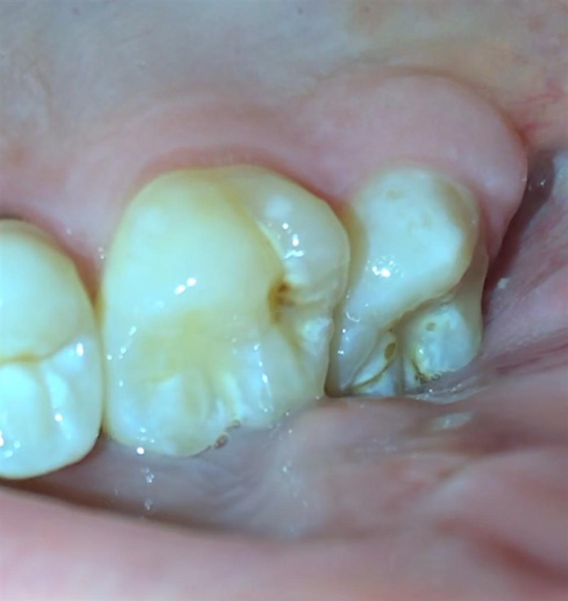 WHAT IS THIS ON MY TOOTH??? STAINING?-example-1