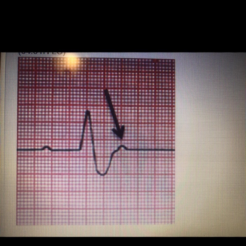 Which statement described the condition of the heart at the point indicated in the-example-1