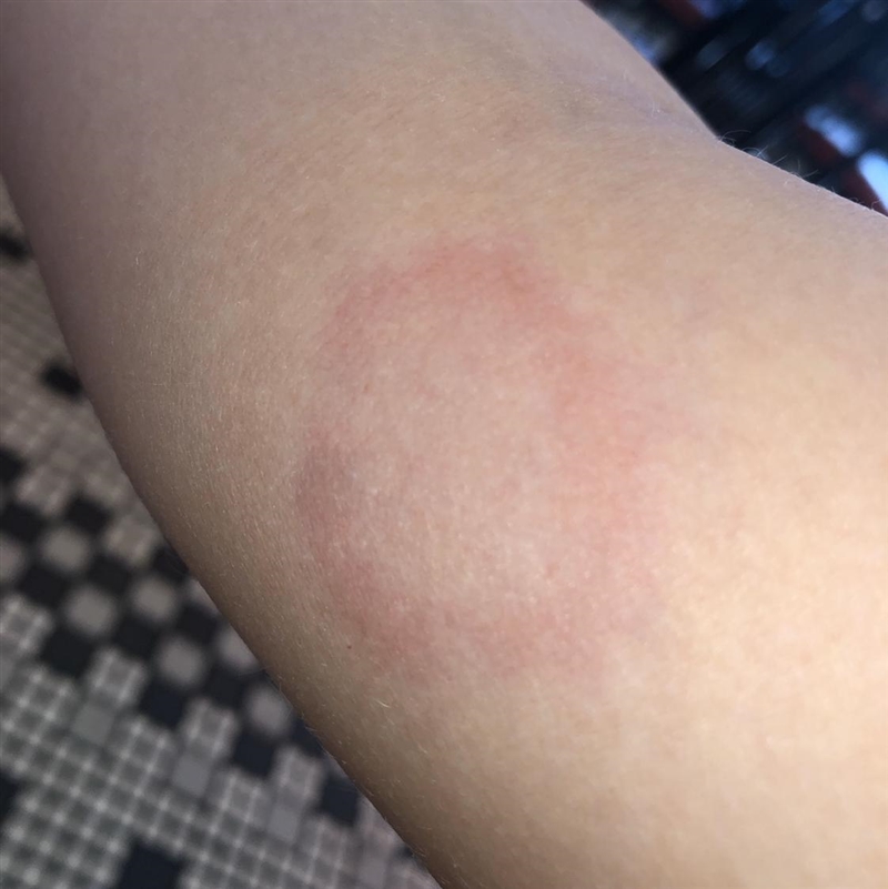 Is this ringworm ???????-example-1