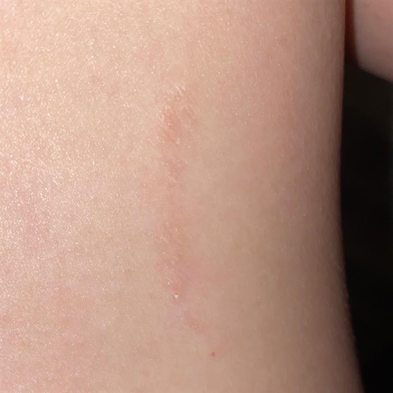 What type of scar is this? Apparently had it since I was a baby. It’s rough and sometimes-example-1