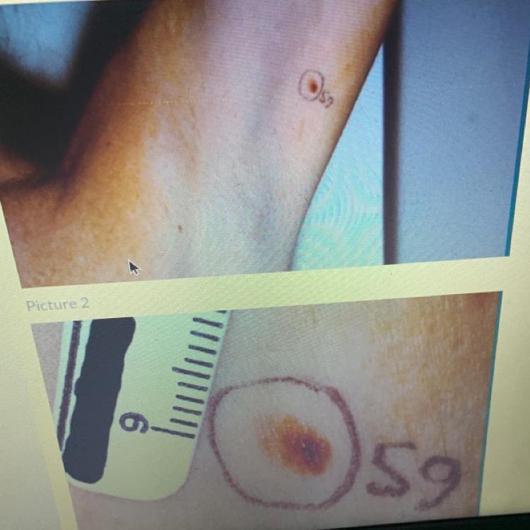 The patient reported that the mole was new and had grown much larger during the previous-example-1