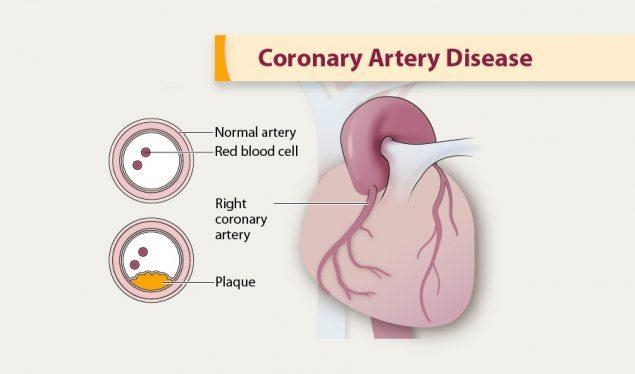 Which type of heart disease cannot be prevented-example-1