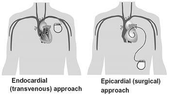 List the two approaches used to insert electrodes for devices that electrically shock-example-1